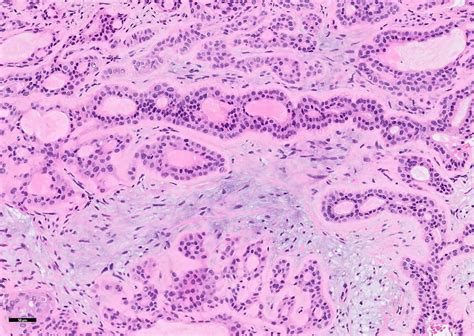 Pleomorphic adenoma causes, symptoms, diagnosis, treatment & prognosis