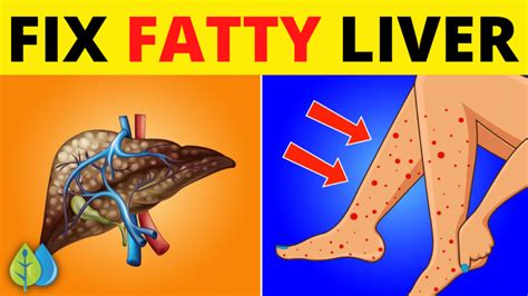 Fatty Liver Disease: 10 Symptoms You Need to Know | DailyHealthPost