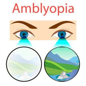 Amblyopia Guide: Causes, Treatment & More | NVISION Eye Centers