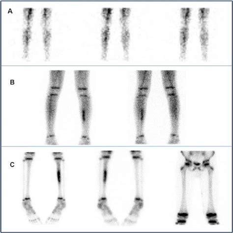 Three-phase bone scan from the legs: Upper row(A): anterior images of ...