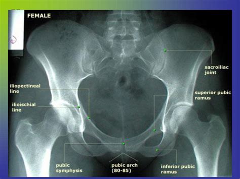 PELVIS & HIPS with Judet views Week 5 - ppt download