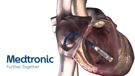 FDA clears Medtronic's miniature Micra transcatheter pacer - MassDevice