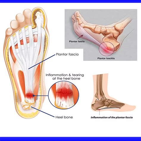 Plantar Fascia Anatomy