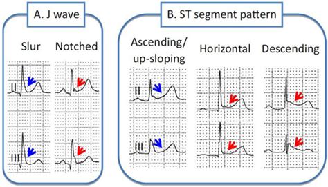 Different aspects of early repolarization (ER). A Slurring/notching ...