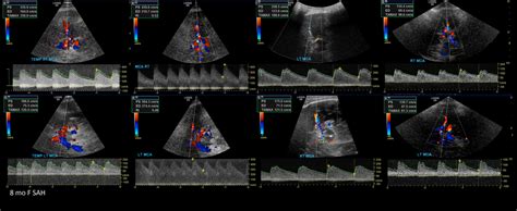 Transcranial Doppler | Vascular ultrasound, Circle of willis, Carotid artery