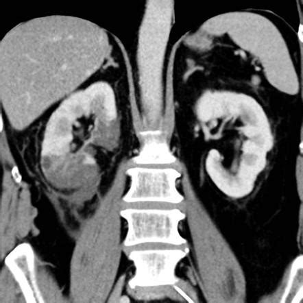 Renal Infarction Ultrasound