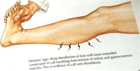 Homan's Sign Examination Test - for Deep Vein Thrombosis (DVT)