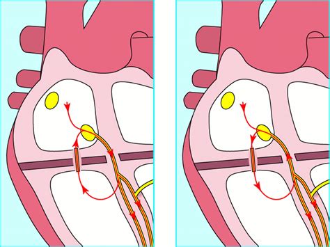 Junctional tachycardias | The BMJ