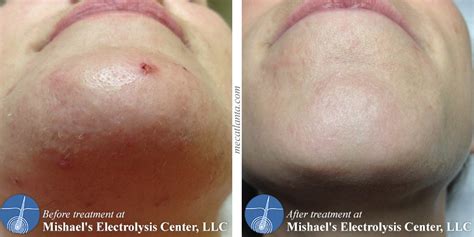 Before & After Electrolysis Hair Removal | Mishael's Electrolysis Center