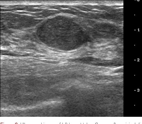 Figure 2 from Breast Cancer Arising Adjacent to an Involuting ...