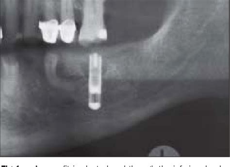 [PDF] Injury to the inferior alveolar nerve during implant placement: a formula for protection ...