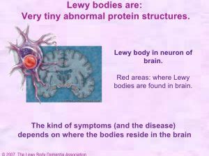 What is Lewy Body Dementia? | Utah | Aspen Senior Care