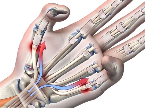 Medmovie.com | Tendon Rupture Following Trigger Finger Release