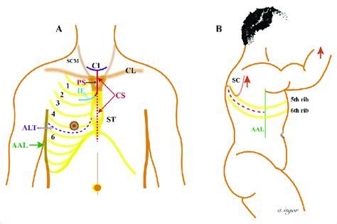 Sternotomy and thoracotomy incisions. (a) Anterolateral thoracotomy,... | Download Scientific ...