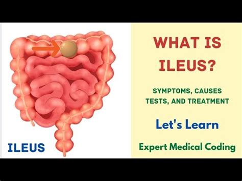 What is Ileus? | Symptoms | Causes | Complications | Tests | Treatment ...