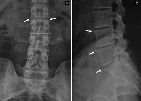 Radiograph of lumbar spine ofMr. Y, anteroposterior and lateral view in... | Download Scientific ...