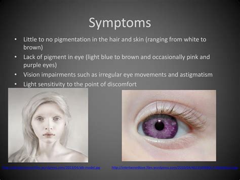 PPT - Albinism PowerPoint Presentation, free download - ID:2109092