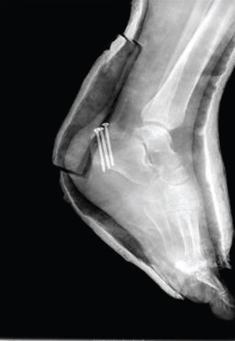 Tongue-Type Calcaneal Fracture due to a Low-Energy Injury