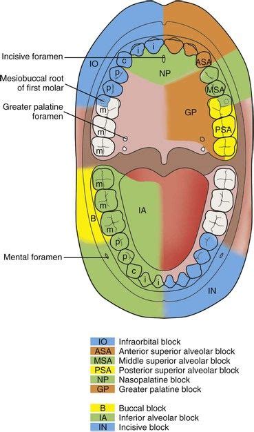 Figure 13-1 Local anesthetic blocks and the structures anesthetized (note that the mental block ...