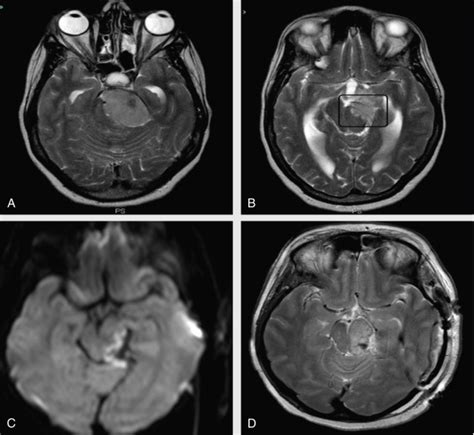 Complications in Posterior Cranial Fossa Surgery | Neupsy Key