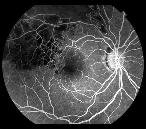 Branch Retinal Vein Occlusion Treatment in New York - Retina Group