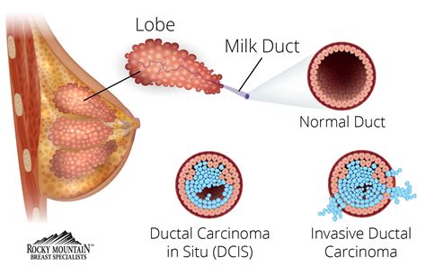 Understanding Breast Cancer Types | Colorado's Breast Cancer Specialists