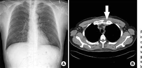 Figure 2 from Primary Sternal Osteomyelitis Caused by Actinomyces israelii | Semantic Scholar