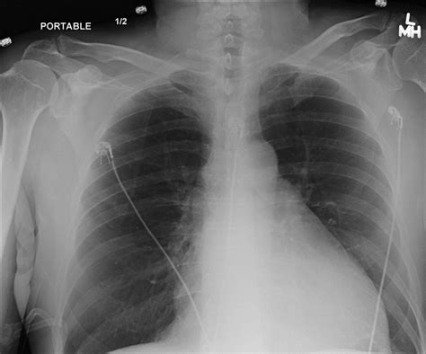 Cardiomegaly X Ray - tacitceiyrs