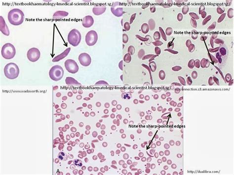 Haematology in a NutShell: Sickle-cell (Drepanocytes)