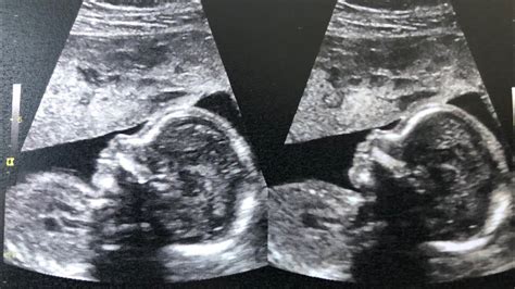 20 week anatomy ultrasound scan - YouTube