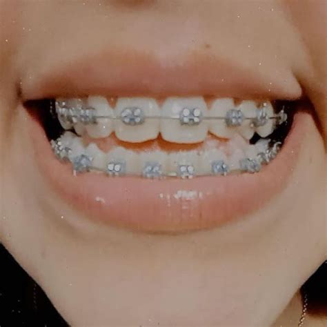 76+ Gorgeous Aesthetic Braces Colors Pictures | nola dalby