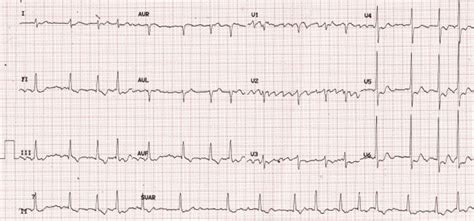 The Simple Guide to Management of Non-Valvular Atrial Fibrillation in the ED - CanadiEM