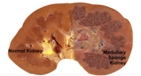 MEDULLARY SPONGE KIDNEY - New