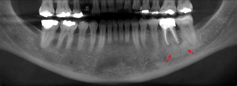 Osteítis Condensante – Dento Metric | Radiología Dental, Oral y ...