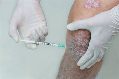 80+ Psoriasis Injection Stock Photos, Pictures & Royalty-Free Images ...