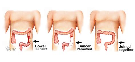 Bowel Cancer | Colorectal Surgeons Sydney