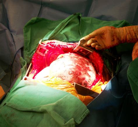 The Clamshell Incision – Thoracic Surgery