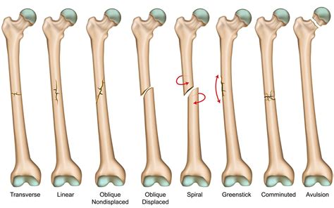 Hip Fracture