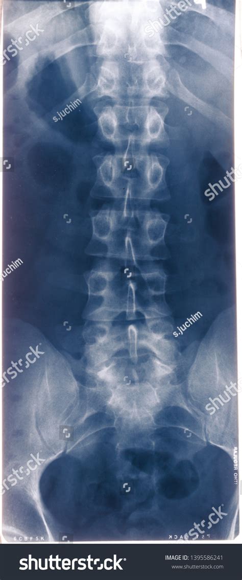 Human Back Bone Xray Examination Photo Stock Photo 1395586241 | Shutterstock