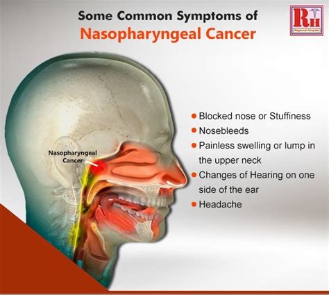 Nasopharyngeal Cancer