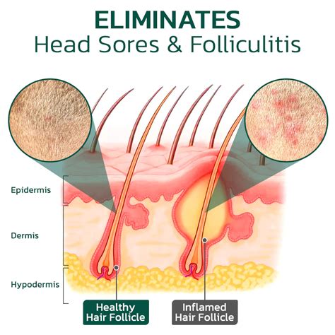 Scalp Folliculitis Treatment - Causes & Cure by Homeopathy