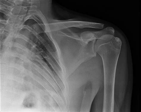 Greater tuberosity of humerus fracture | Image | Radiopaedia.org