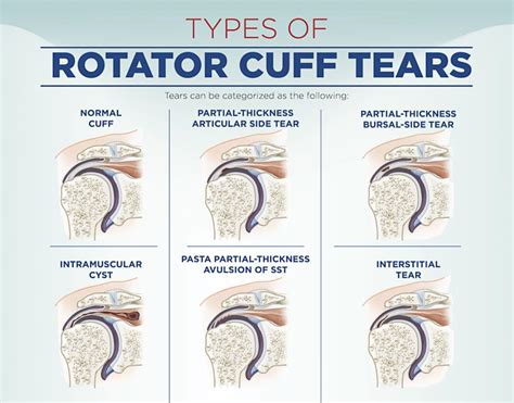 Rotator Cuff Injury Types