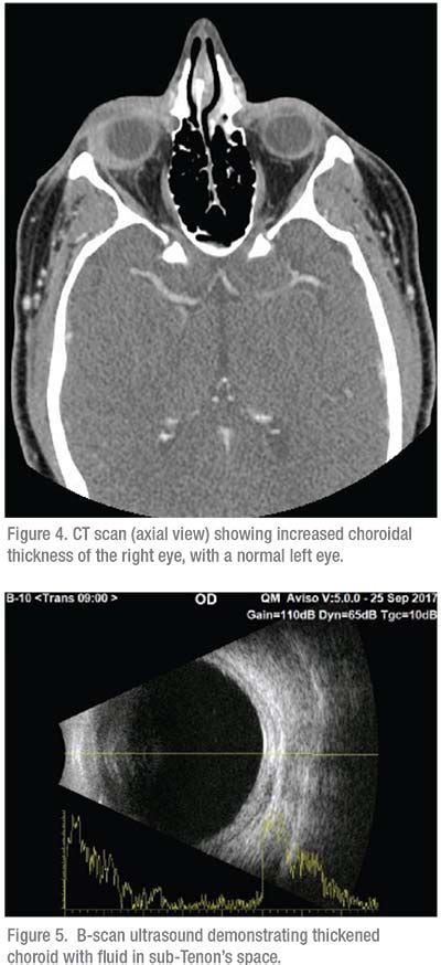 Posterior Scleritis: A Diagnostic Challenge