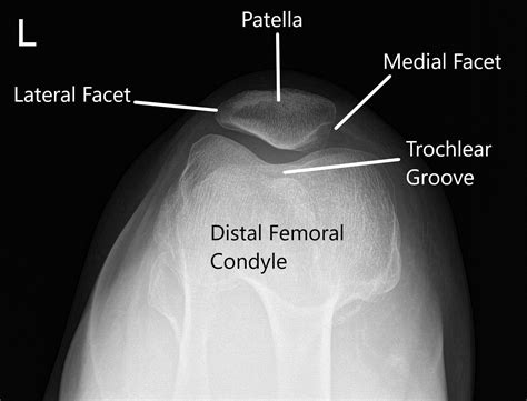 Case Study: Patellofemoral Chondroplasty in 60 yr. Old Female