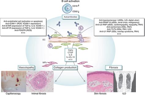 Pathogenesis Of Systemic Sclerosis