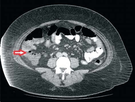 Acute Appendicitis On Ct Scan