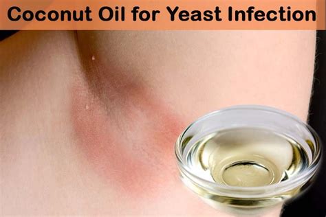 How To Use Coconut Oil To Treat Yeast Infection?