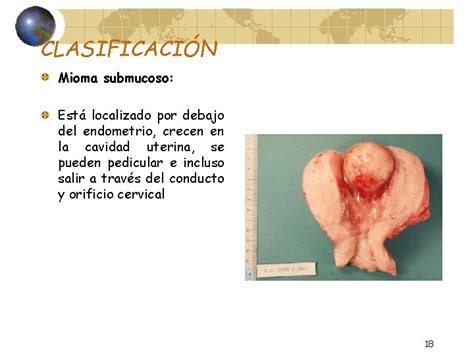 MIOMATOSIS UTERINA DR FRANCISCO DEL PALACIO GINECOLOGO Y