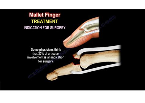 Mallet finger Treatment — OrthopaedicPrinciples.com